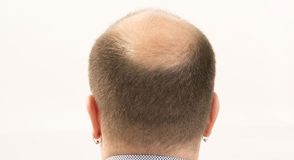 Calvitie, pelade et alopecie